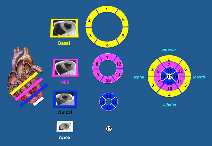 17 segment AHA model