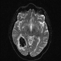 T2 blackout diffusion MRI