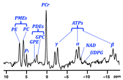 ³¹P brain spectrum