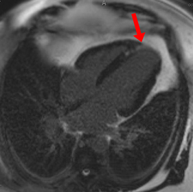 delayed enhancement myocardial infarction