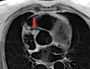 black blood right coronary artery