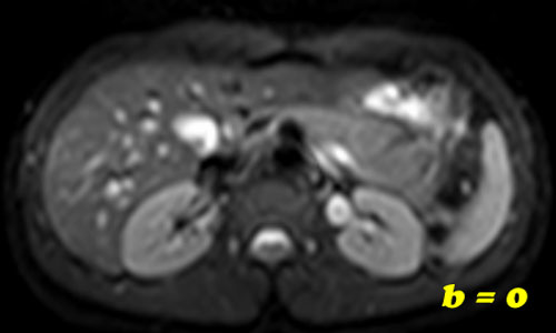 Diffusion MRI b-value