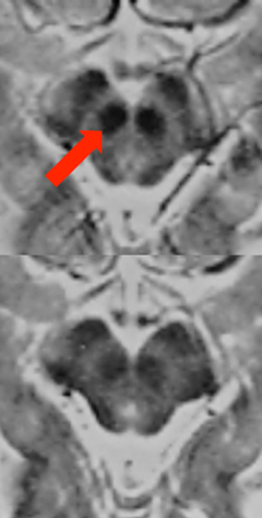 Fast SE/Turbo SE decreased susceptibility