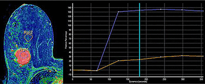 Breast DCE curve