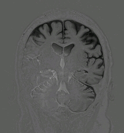 phase-sensitive IR artifact