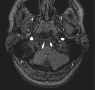 Gradient echo imaging flow effects