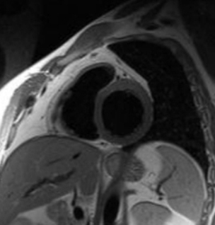 short-axis double IR image of heart