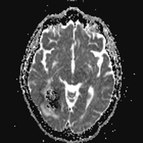 T2 blackout diffusion MRI