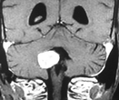 Gadolinium (Gd) contrast enhancement