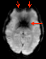 epi distortion