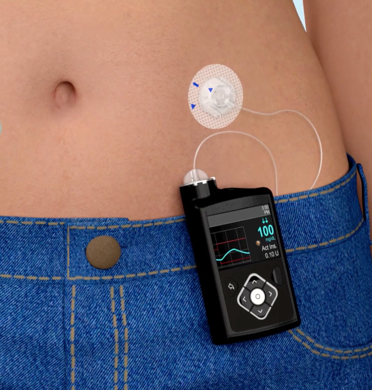 insulin-pumps-glucose-meters-questions-and-answers-in-mri