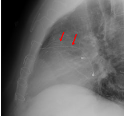 epicardial pacing wires