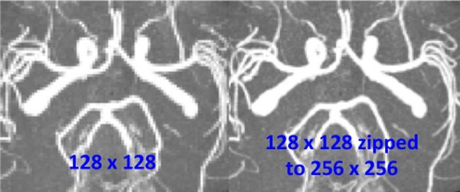 Zero-Interpolation Filling (ZIP) in MRA