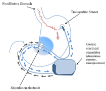 abiliti stimulator