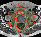 outer volume suppression MRI