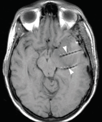 deep electrode MR artifact